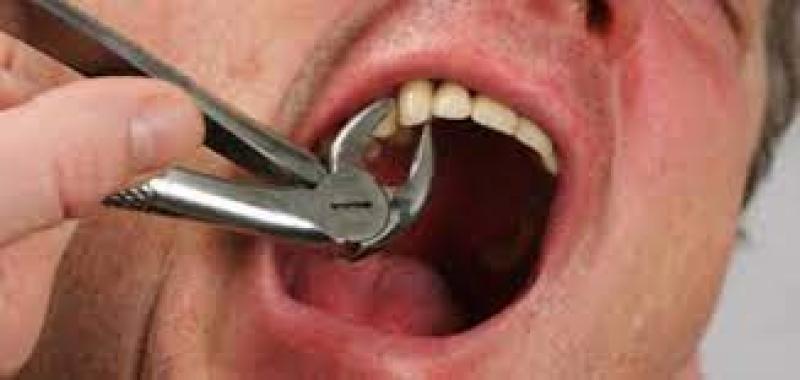 في واقعة مروعة : عامل نظافة ينتحل صفة طبيب أسنان ويخلع أسنان مريض