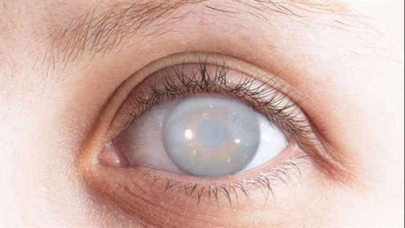 أعراض الإصابة بالمياه البيضاء على العين، وأهم علاجاتها