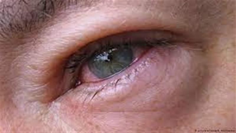 التهابات العين