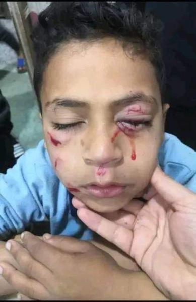 ”طفل في طنطا يفقد عينه بسبب الألعاب النارية: حادث مروع يلقي الضوء على خطورة الصواريخ النارية”