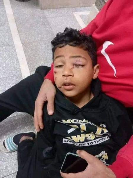 طفل مصاب بسبب الالعاب النارية