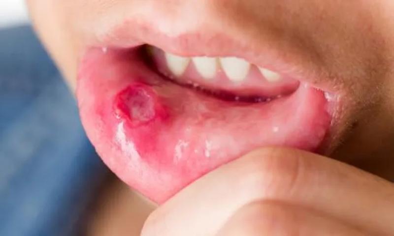 عوامل تُزيد من خطر الإصابة بتقرحات الفم.. حاول تجنبها
