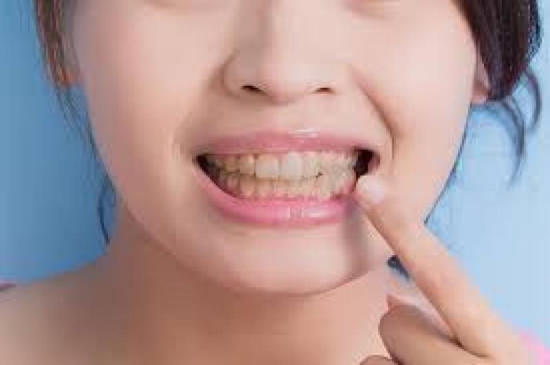 عادات تغير لون الأسنان: تعرف عليها