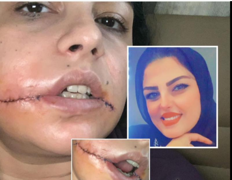 ”شوّه وجهي لأني قلت لا”.. صرخة فتاة من بورسعيد تكشف جريمة  بشعة في حي الزهور