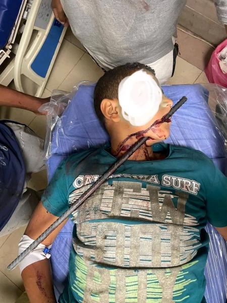 مستشفى سوهاج الجامعى ينقذ طفلا بجراحة نادرة لاستخراج سيخ معدنى اخترق الرقبة