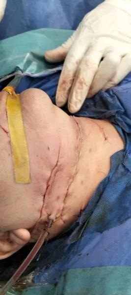 فريق طبى بمستشفى جامعة سوهاج ينجح في إنقاذ سيدة من الموت عقب إصابتها بجروح قطعية متعددة و طعنة عميقة بالرقبة