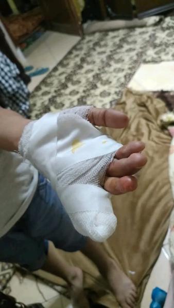 قطع اصبع طفل في دمياط.
