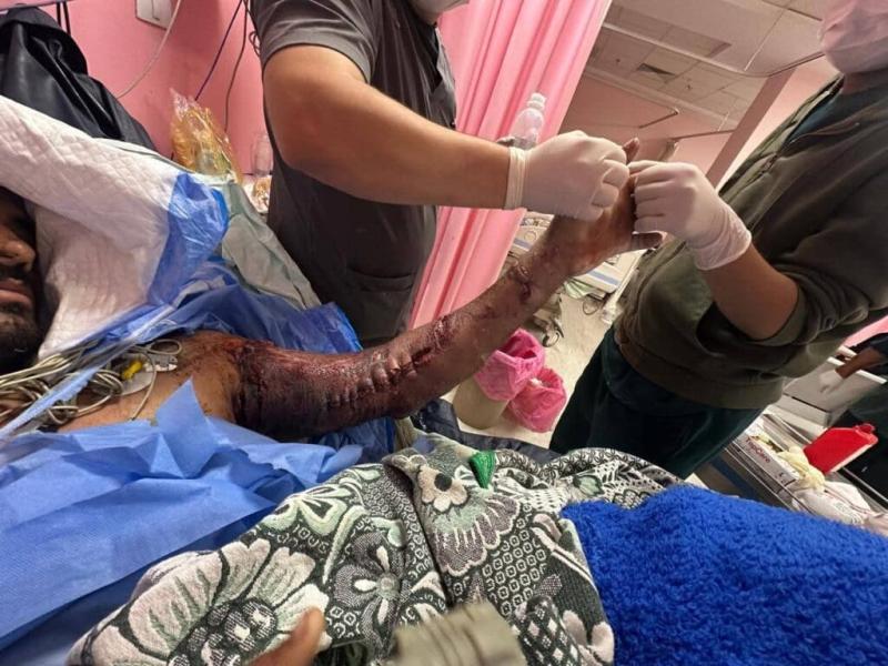 إنجاز طبي بسوهاج الجامعي.. إنقاذ حالتين من بتر مؤكد بإعادة توصيل الشرايين والأعصاب