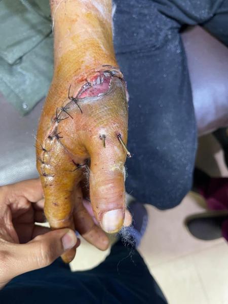 انقاذ شاب تعرض لبتر كامل بإصبع الابهام نتيجه ساطور بمستشفى سوهاج الجامعي