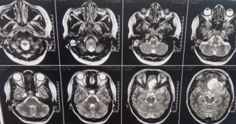 استئصال ورم ضخم بقاع الجمجمة لمريضة بمستشفى سوهاج الجامعى