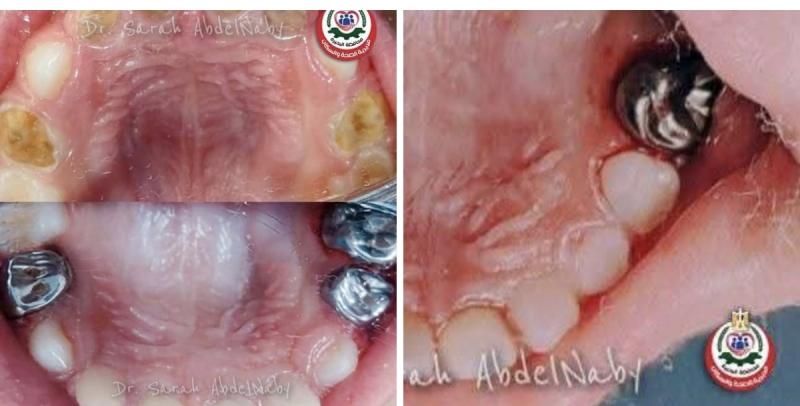 صحة البحيره.. اجراء تدخلات جراحية متقدمة بقسم الأسنان بمستشفى الأطفال التخصصي .